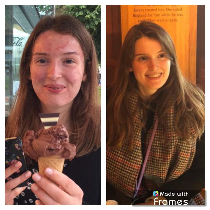 Hormonal Acne Birth Control Effects Reddit Photos Ellie