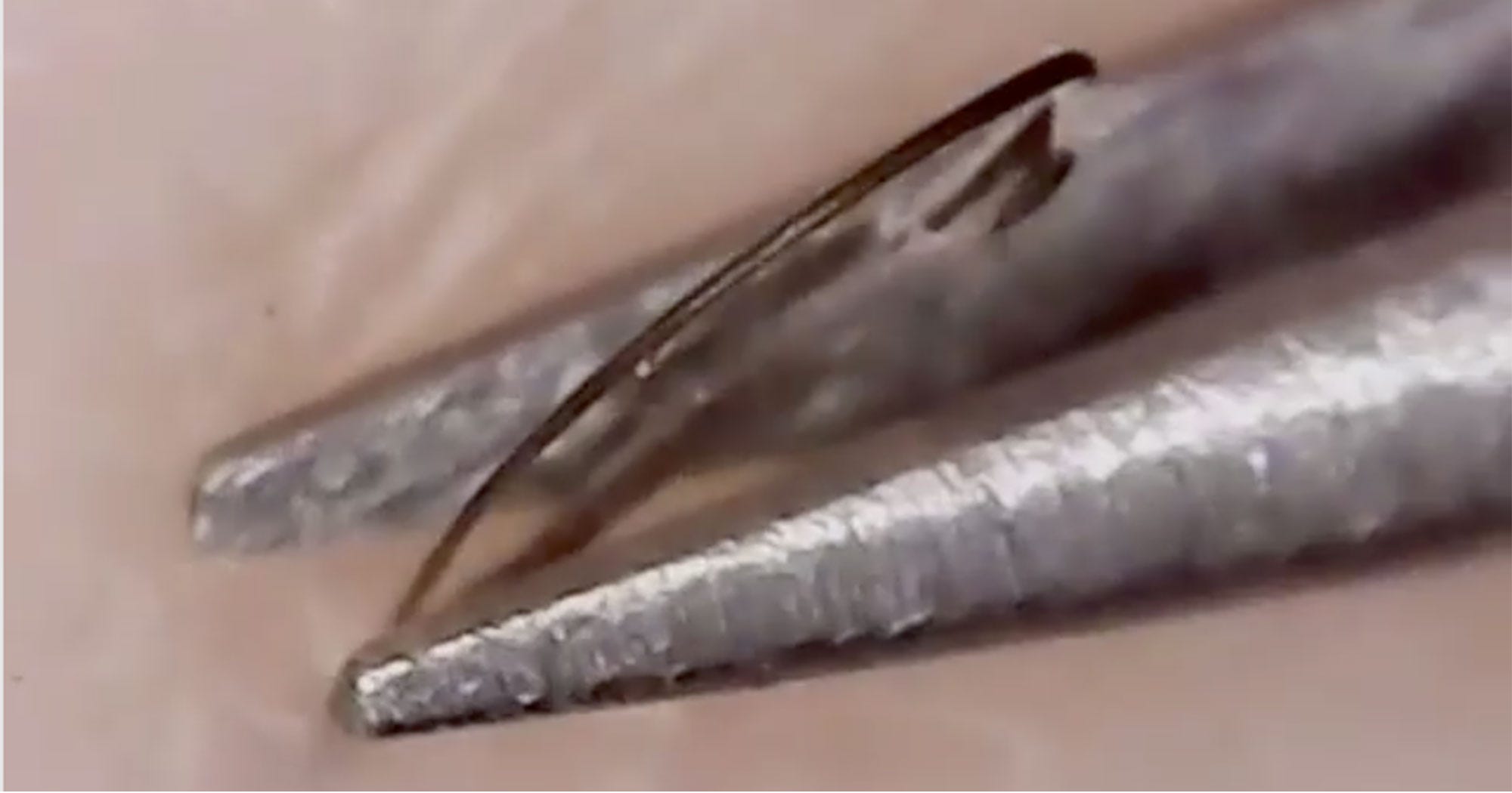 Can tweezing cause ingrown hair Clearance