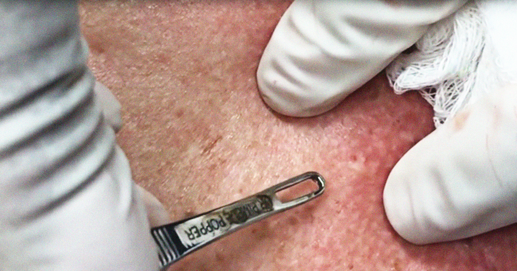 Dr Pimple Popper Blackheads In Ears